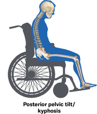 Clinical Illustration_Posterior Pelvic Tilt
